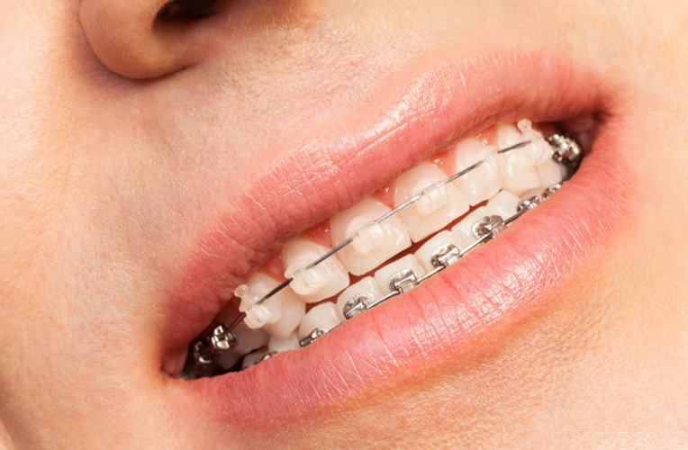 四、球面托槽的适用性限制