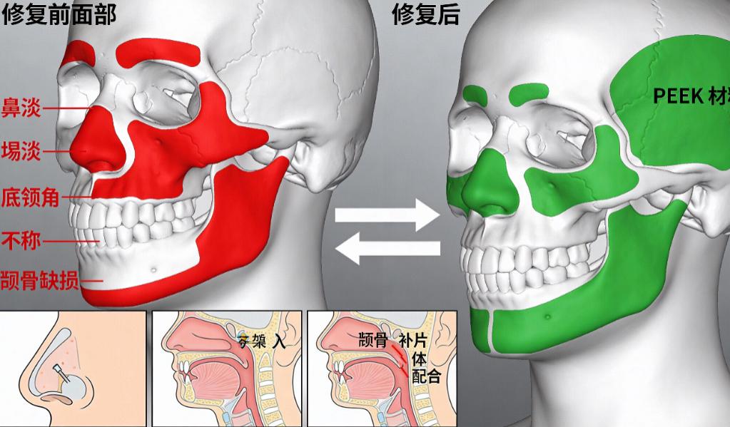 纯钛支架和匹克支架哪个好？2026年材质耐用性价格对比全解析！