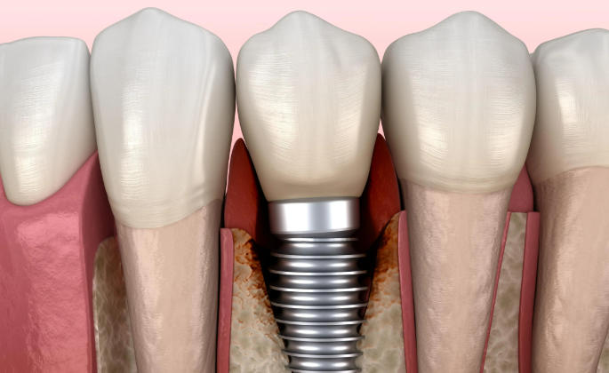 三、美国植牙材料价格：常见误区与注意事项