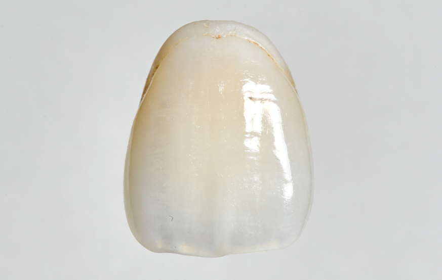 美嘉贴面是进口的吗？2026年美嘉瓷贴面价格和材料全解析