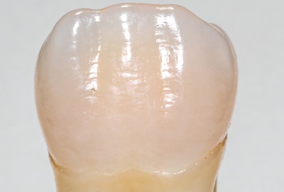 三、美嘉贴面与进口品牌的对比