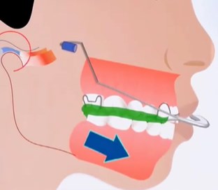 二、12-18岁牙齿矫正神器:矫正过程中的注意事项与常见误区