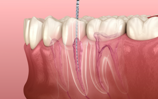 三、多根管治疗(复杂病例):价格区间在1000元~3000元/颗