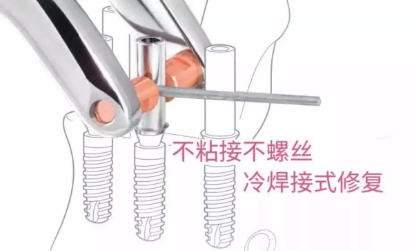 威高种植体是德国生产的吗？国内威高集团自主研发优秀植体