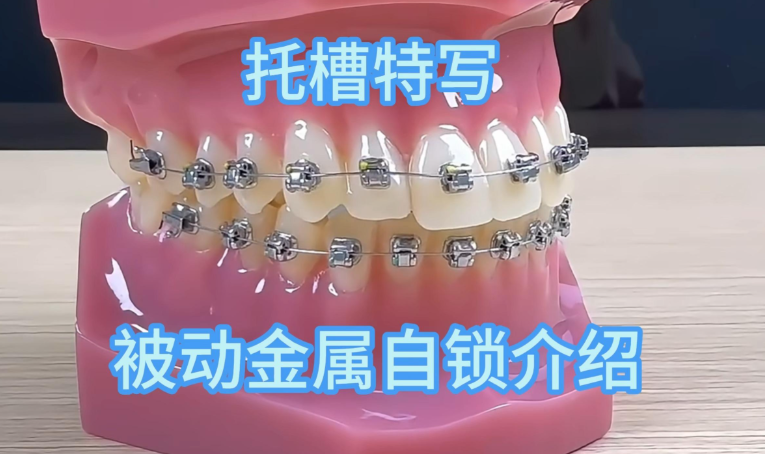 美国奥美科damonq金属自锁托槽矫正器，戴更舒适，容易清洁