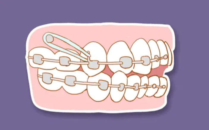 二、美国奥美科 Damon Q 金属自锁托槽的优势