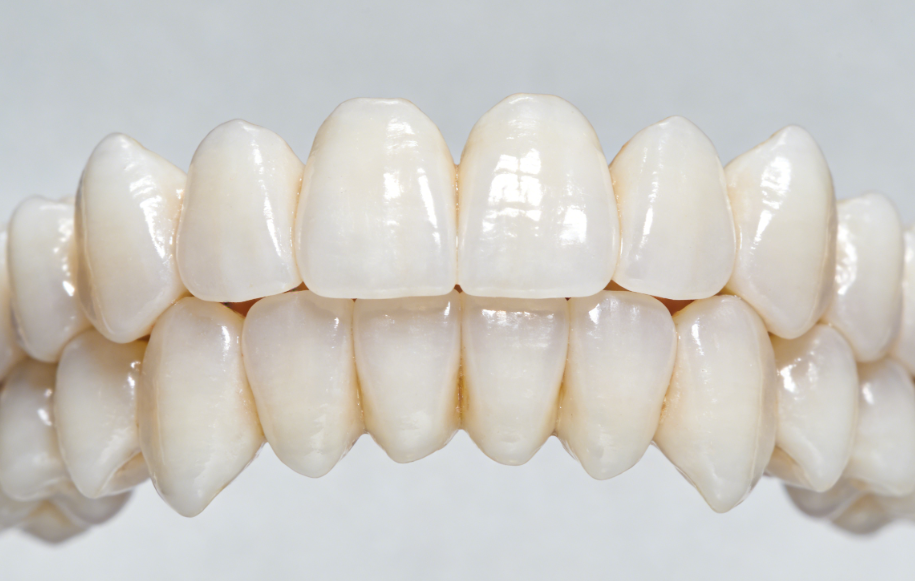 五、爱尔创贴面的缺点