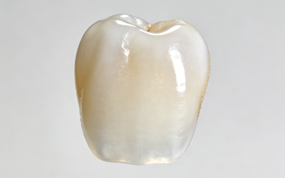 六、爱尔创贴面的使用建议