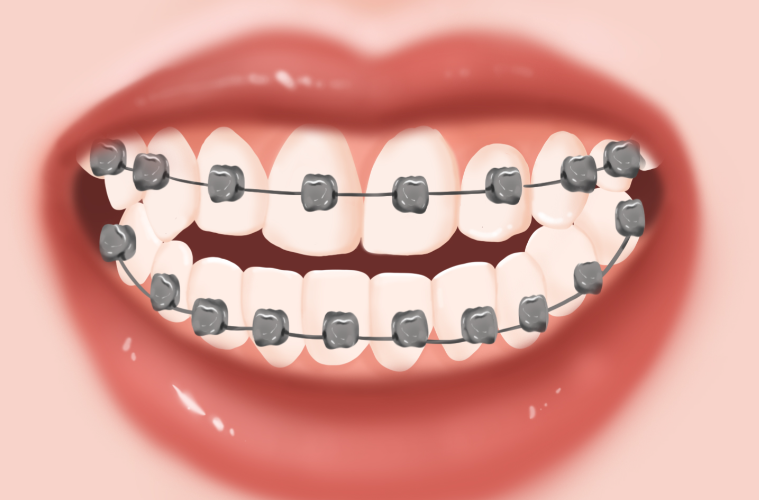 鸡西矫正牙齿多少钱不同品牌价格对比2.8万和3.6万，哪种方案性价比最高？
