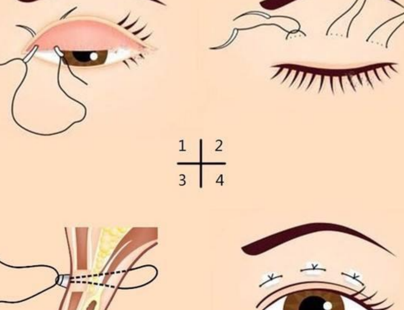 七、库尔勒全切双眼皮医院推荐的就诊攻略