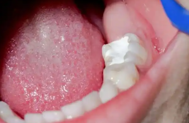 儿童玻璃离子补牙多少钱一颗？一般在200元起适合乳牙浅中龋