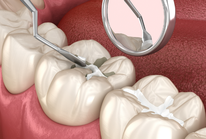 二、儿童玻璃补牙的适用情况与治疗原理
