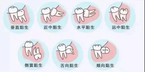 三、西安高新医院拔智齿怎么样？团队确保手术安心