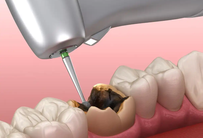 五、总结:漳州市医院补牙齿多少钱一颗?