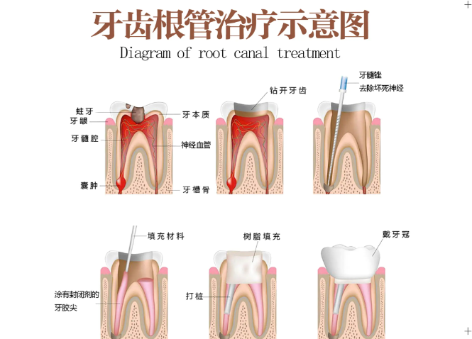 三、来宾根管治疗多少钱一颗牙?医疗保险报销影响自费部分