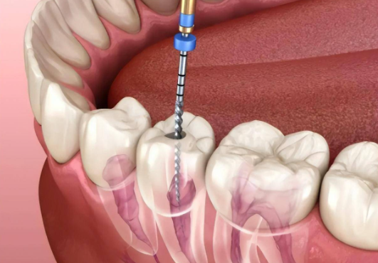 七、来宾根管治疗多少钱一颗牙?如何查询具体价格