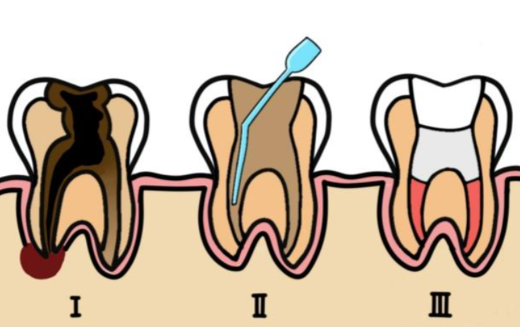 八、总结:来宾根管治疗多少钱一颗牙?价格区间参考