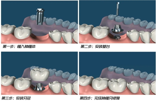 三、选色操作步骤｜从初诊到修复的全流程