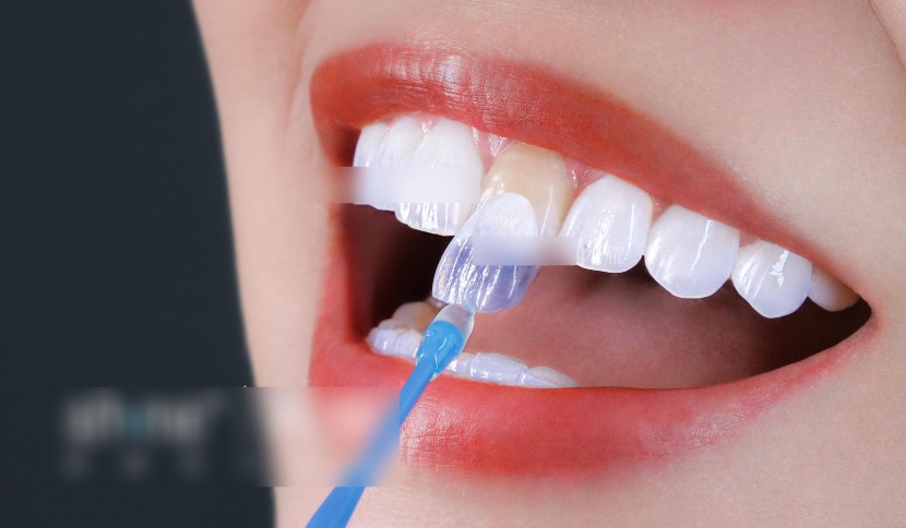 二、美加瓷贴面质量与进口品牌对比