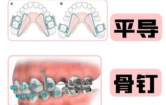 隐适美隐形矫正优缺点全攻略：价格透明度+效果可视化解析，选对牙套不踩雷！