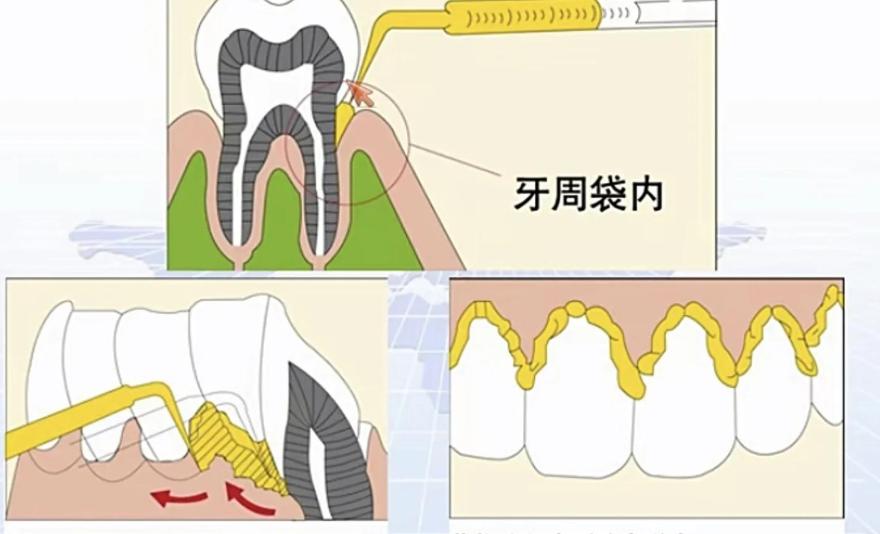 三、正雅gs版和经典版区别:佩戴体验与医生资质要求