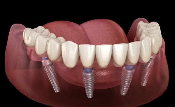 三、如何根据个人情况选择士卓曼种植体型号？