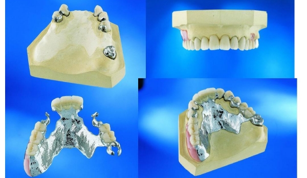 二、临时假牙能戴多久？科学界定使用周期与限制