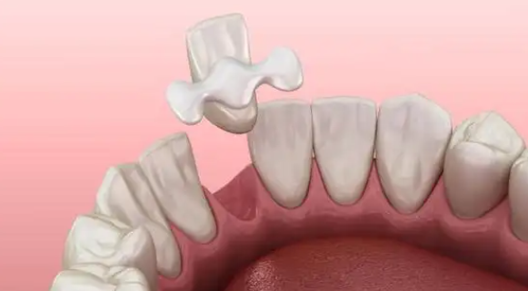 二、马里兰桥取下前的注意事项