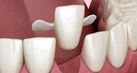 马里兰桥怎么取下来？2026年最新方法揭秘！