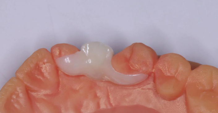 三、马里兰桥拆除后的护理与选择