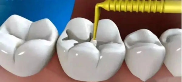 银川补牙最好的医院排名怎么选？鸣晨口腔数字化技术+艾齿口腔隐形矫正更突出