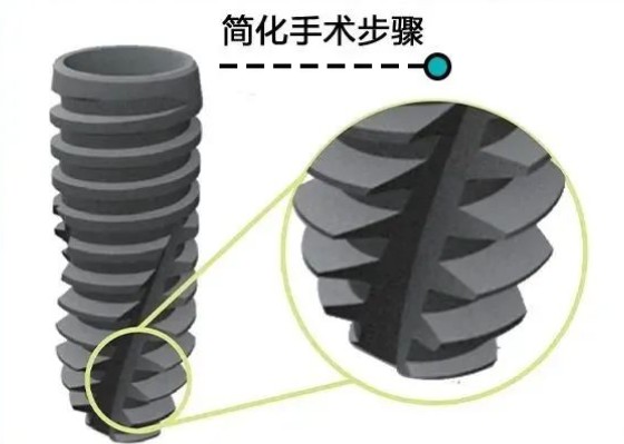 韩国奥齿泰标准版种植体怎么样？使用寿命+价格全解析 用户真实反馈揭秘