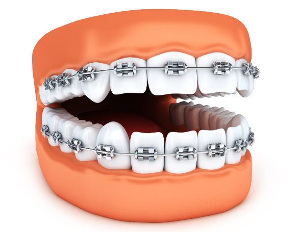 二、3M自锁托槽型号对照表：如何匹配个人需求