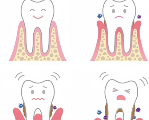 三、牙龈退缩与牙龈开裂的关键区别