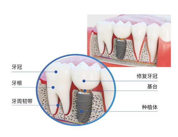 德国acm种植体跟icx哪个好？材料+价格+用户评价全解析，2026年最新对比！