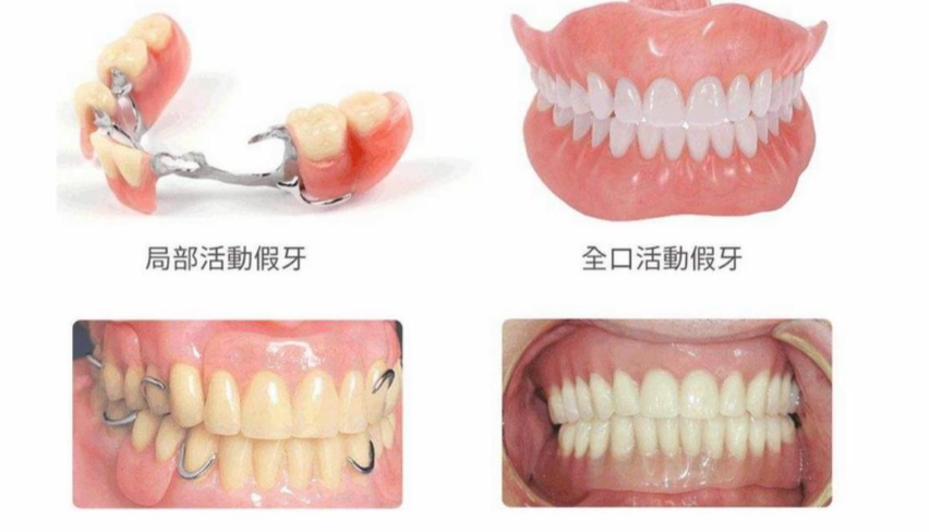 吸附性义齿优缺点全解析：3D吸附技术优劣对比+用户真实体验揭秘（附数据）